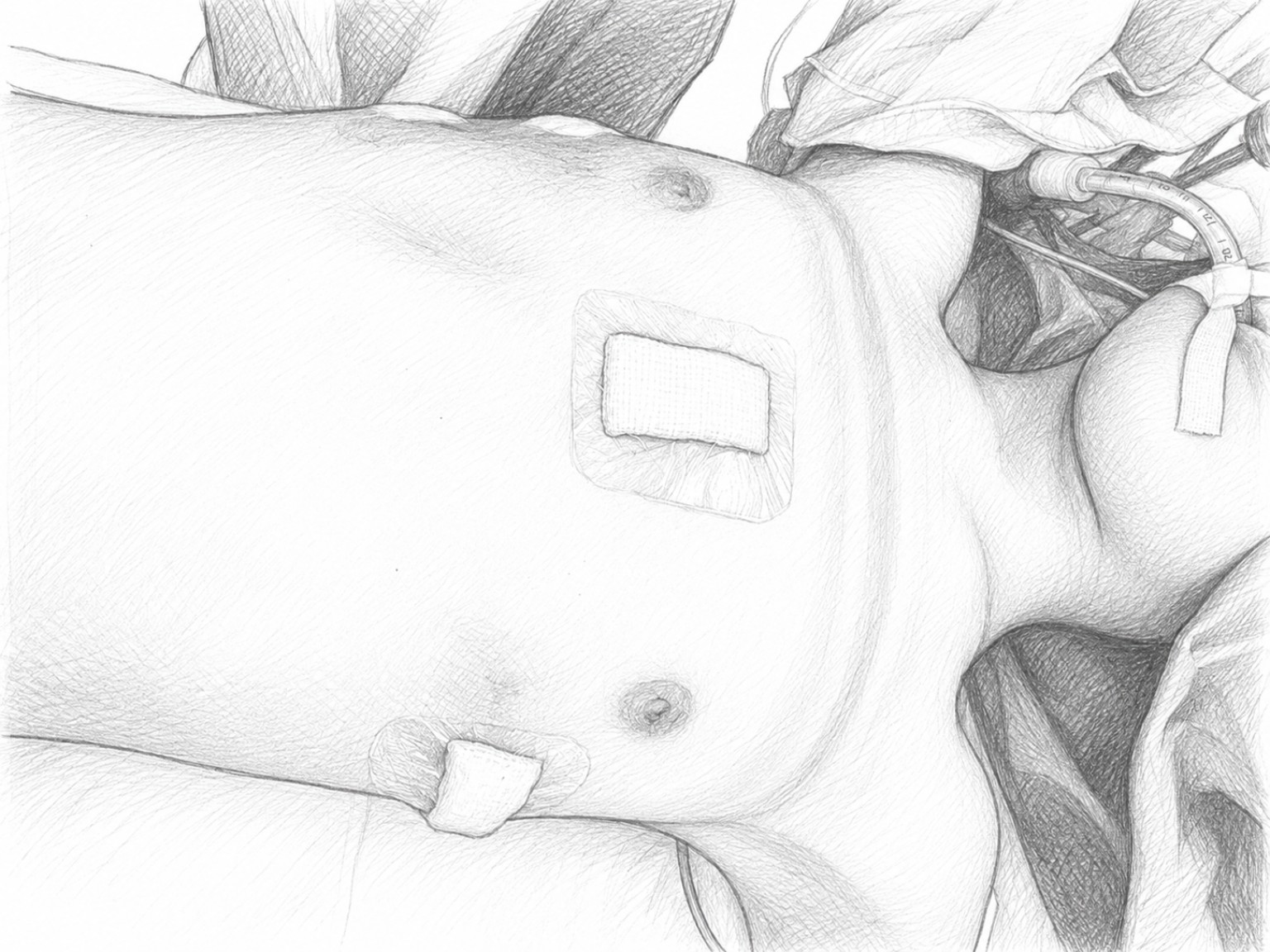 Chest contour and small dressings immediately after Nuss pectus repair in this case